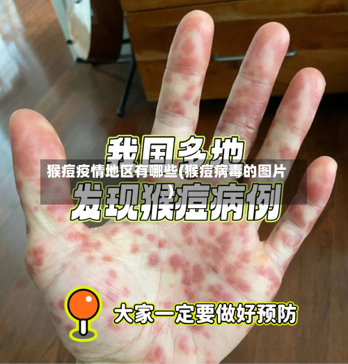 猴痘疫情地区有哪些(猴痘病毒的图片)
